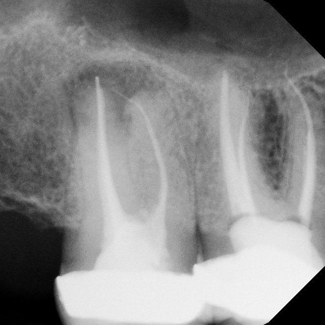 Before Endodontic Treatment Case 2 - Harp Endodontics Manhattan New York